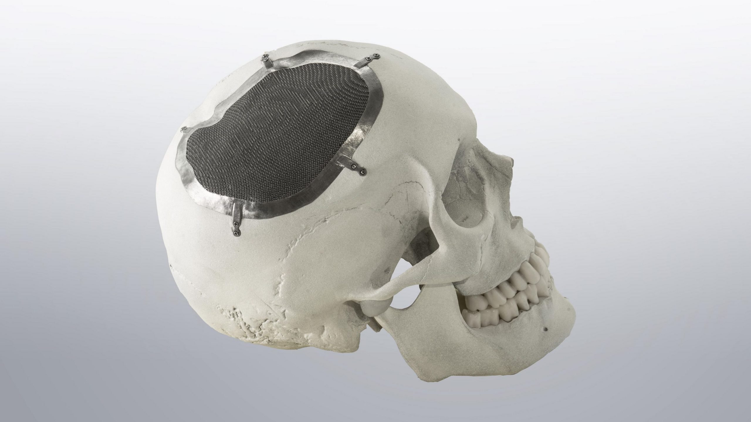 csm_trumpf-additive-manufacturing-skull-implant_b05e27cd59_0b452c96b5